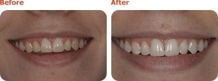 whitening_before_after