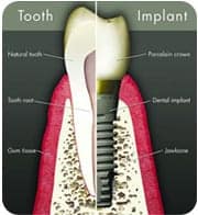 dental_implant_sm