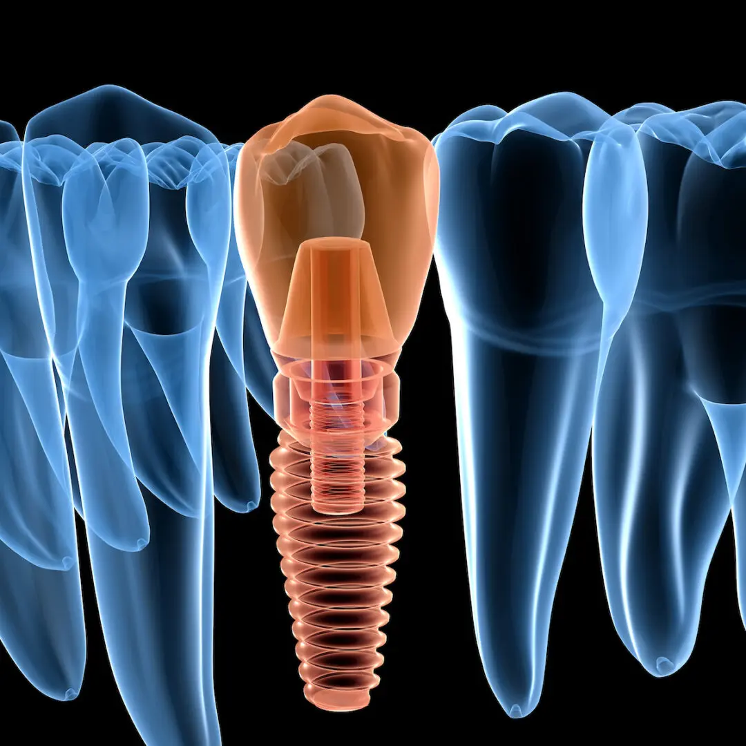 Single tooth dental implant Allstar Implants Plus