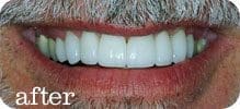 Dental Implants Joliet 44 Here's an alt tag for the image: After: Man's bright, even smile.