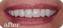 Dental Implants Joliet 26 After: bright, white smile makeover.