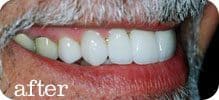 Dental Implants Joliet 42 Here's an alt tag for the image: "After: Man's smile with new teeth"