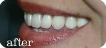 Dental Implants Joliet 34 Here's an alt tag for the image: `After image: bright, healthy smile`