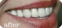 Dental Implants Joliet 30 Here's an alt tag for the image: `After: Close-up of a smile with bright teeth.`